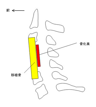 頸椎前方固定術横