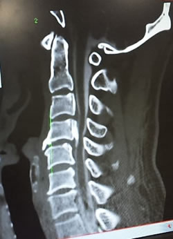 頸椎前方固定術手術前横